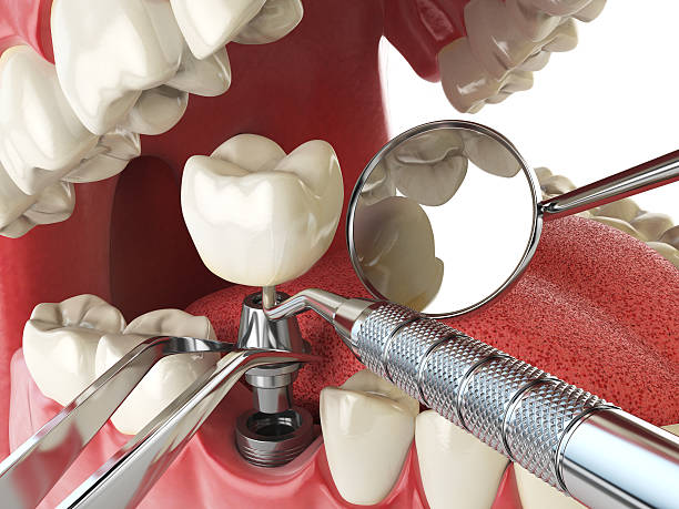 Best Emergency Tooth Extraction in Alsip, IL
